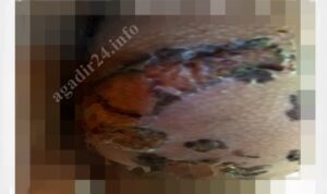 حروق بليغة في مؤخرة تلميذة ضواحي أكادير تستنفر المصالح الأمنية +”صورة”