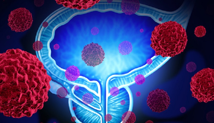 علاج سرطان البروستات..الذكاء الاصطناعي (AI)  يجنب آلاف الرجال العلاج غير الضروري والآثار الجانبية