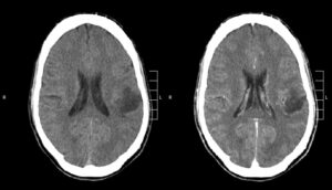الاستفادة من جزيئات الذهب المشحونة للقضاء على سرطان الدبقي