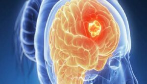 علاج جيني مبتكر يثير الأمل في مكافحة سرطان الدماغ الشديد العدوانية