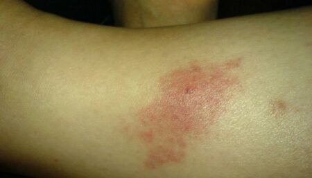 تزنيت : جماعة إملن تكشف مستجدات إصابة تلاميذ بداء "الليشمانيا" الجلدي