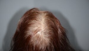 6 أغذية لمحاربة تساقط الشعر 9 Chute de cheveux