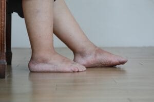 احتباس السوائل في القدم1
