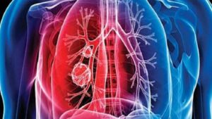 تزنيت: جمعيون يدعون إلى تفعيل المراقبة لمواجهة مخاطر مرض السل 1 tuberculose