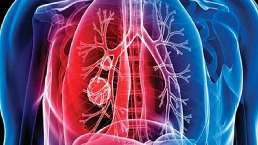 tuberculose