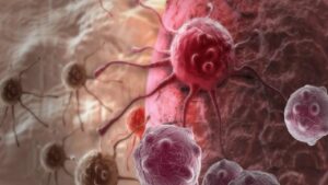 cancer du sein hereditaire