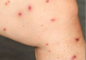 داء الليشمانيا يدق ناقوس الخطر بالجنوب الشرقي: إصابات جديدة تقلق الساكنة وتستدعي تدخلات عاجلة