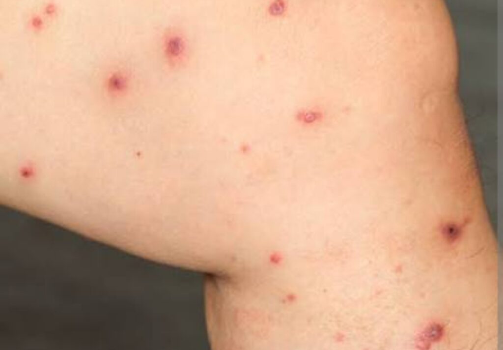 السلطات الصحية بطاطا تطلق حملة استباقية لمكافحة داء “الليشمانيا”